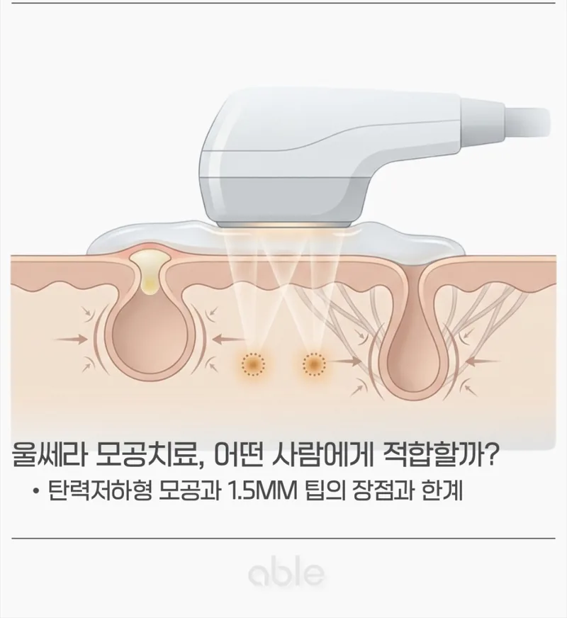 울쎄라 1.5mm 팁이 모공 주변 진피층에 열응고점을 형성하는 단면 일러스트